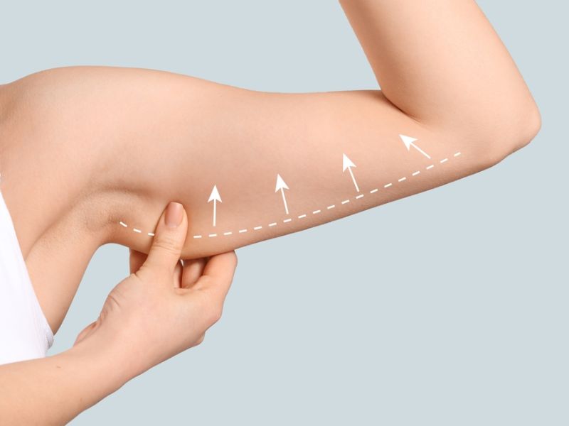 tiêm botox bắp tay